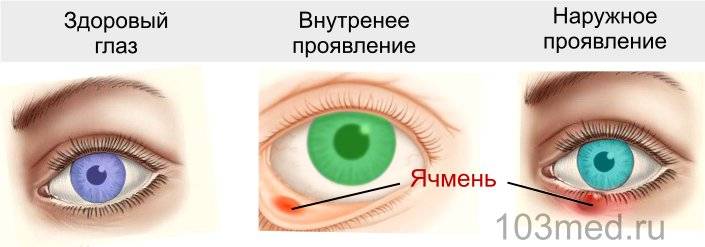 Виды ячменя на глазу, глазного ячменя