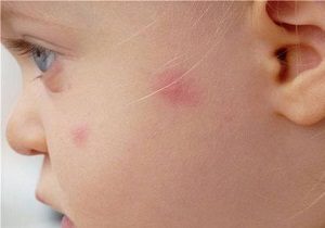 Чешется лицо и появляются красные пятна